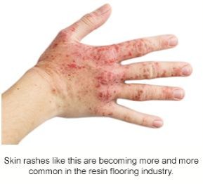 A hand with a painful red rash all over the back and fingers.