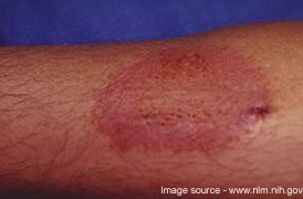 A large circular rash on the arm that can occur with skin senstisation.