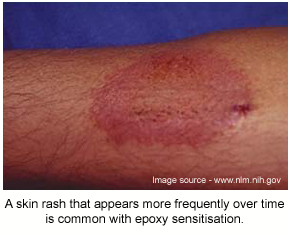 A large circular rash on the arm that can occur with skin senstisation.